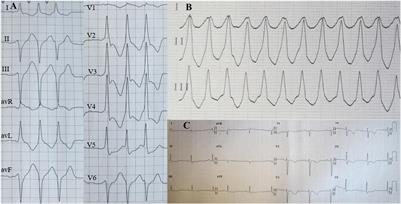 A Rare Case of Isolated Right Ventricular Non-compaction With the Novel TTN Mutation